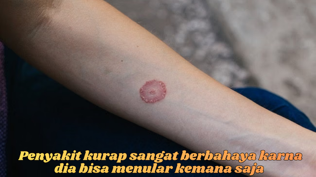 penyakit kurap
