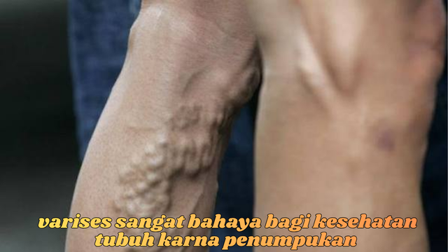 penyakit varises