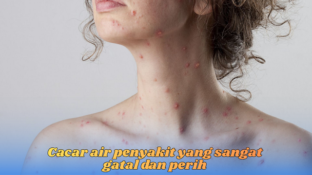 penyakit cacar